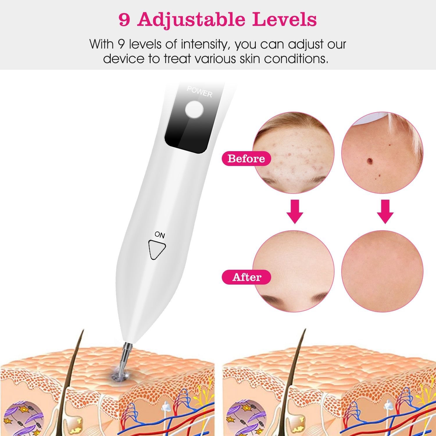 Skin Tag Repair Kit Portable Beauty Equipment Multi-Level with Home Usage USB Charging LCD Level Adjustable 6 Replaceable Needles - Image 4